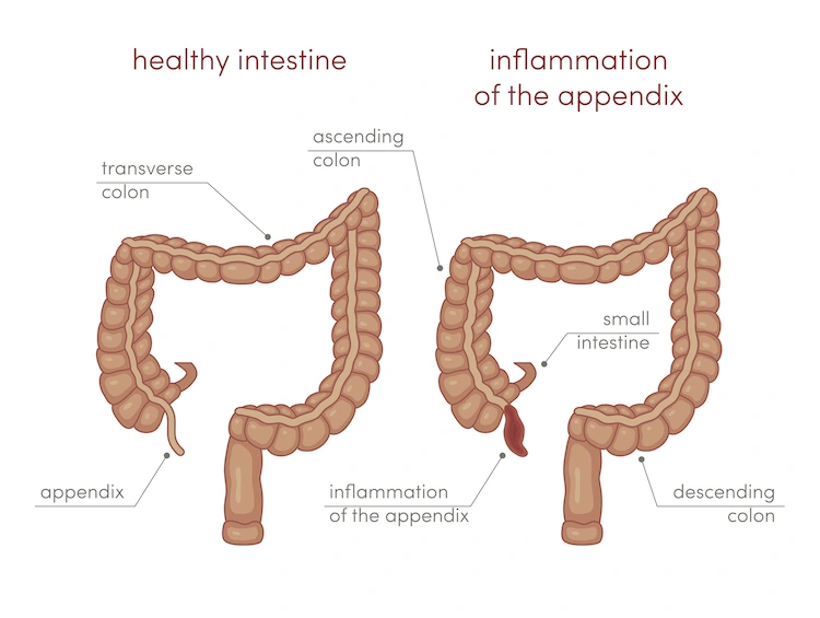 appendicitis diagram