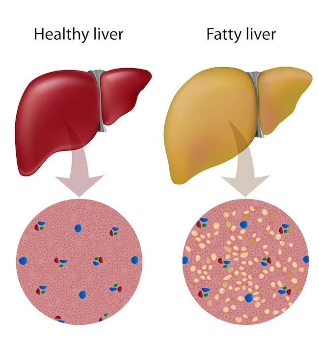 fatty liver disease diagram