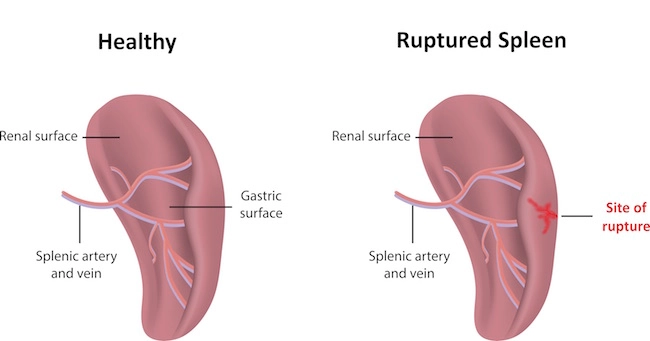 healthy versus ruptured spleen diagram