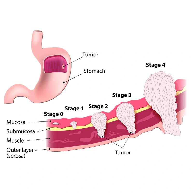 stomach cancer diagram
